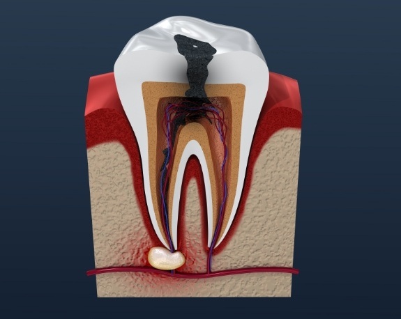 Animated model of damaged tooth with infection in bottom of root