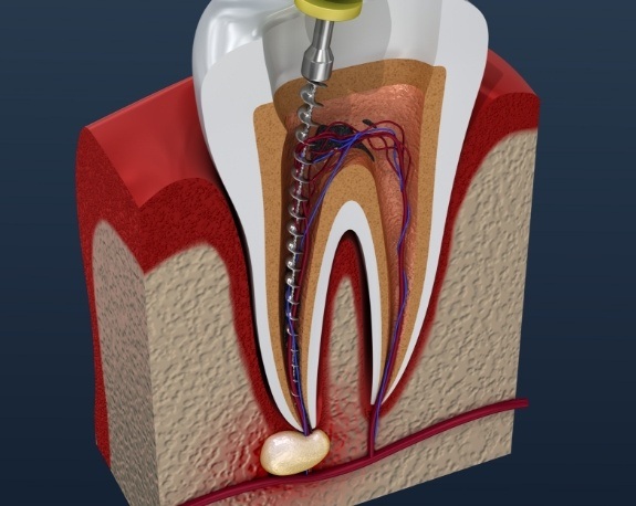 Animated dental instrument cleaning out root of tooth