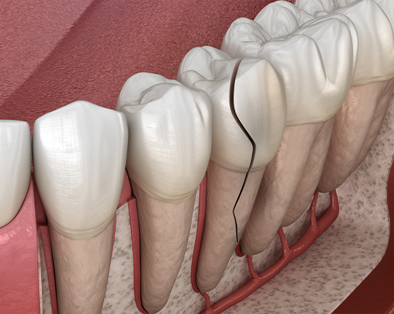 Close up of animated broken tooth needing cracked tooth treatment in New York City