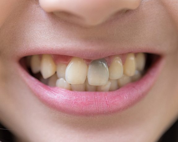 Closeup of an internally discolored tooth