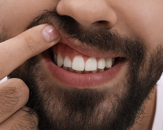 Close up of man pointing to his smile after lightening darkened teeth in New York City