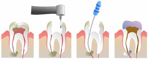 illustration of root canal