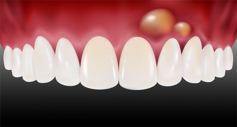 A 3D illustration of a bump on one&rsquo;s gums
